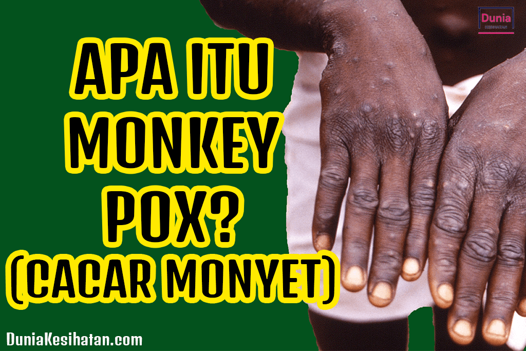 Apa itu Monkeypox Cacar Monyet